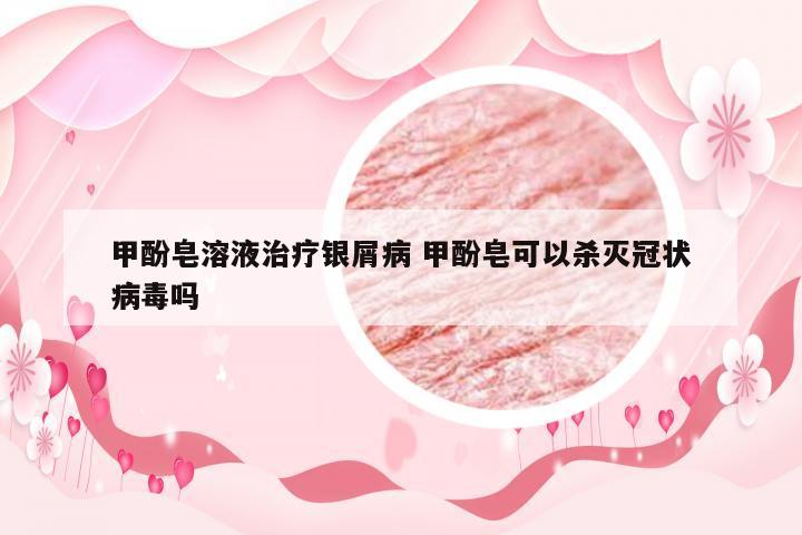 甲酚皂溶液治疗银屑病 甲酚皂可以杀灭冠状病毒吗