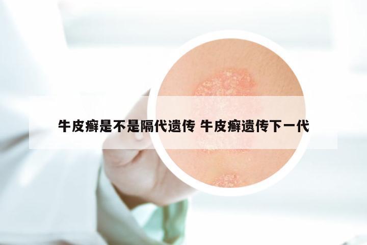 牛皮癣是不是隔代遗传 牛皮癣遗传下一代