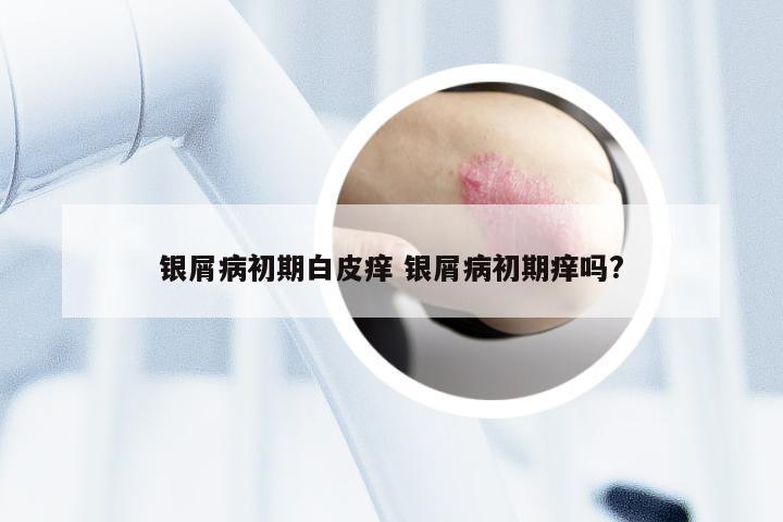 银屑病初期白皮痒 银屑病初期痒吗?