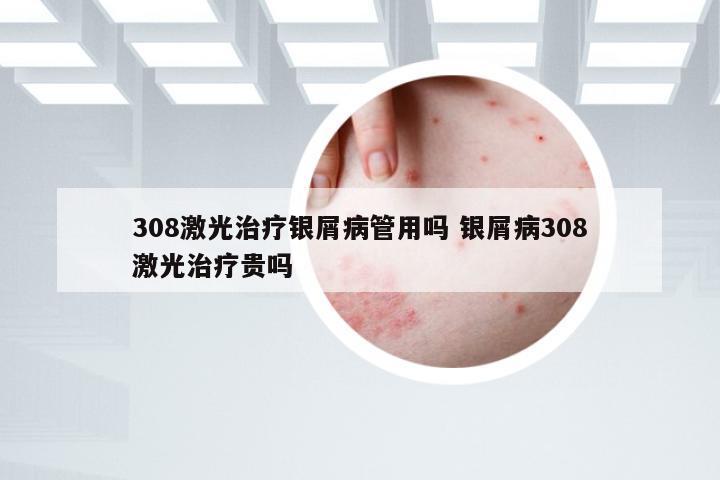 308激光治疗银屑病管用吗 银屑病308激光治疗贵吗