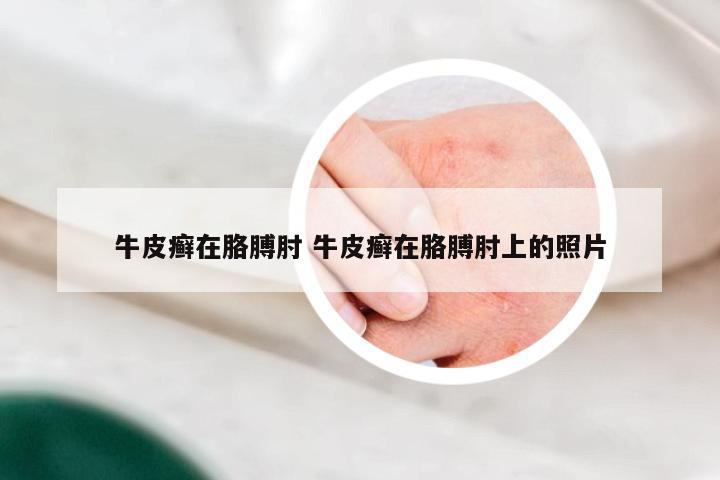 牛皮癣在胳膊肘 牛皮癣在胳膊肘上的照片