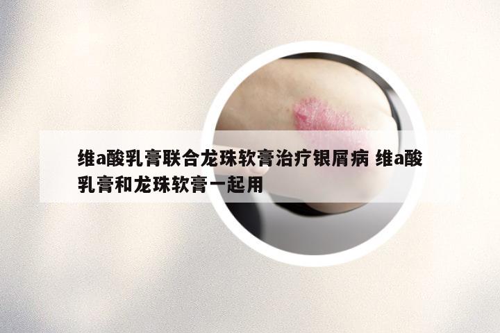 维a酸乳膏联合龙珠软膏治疗银屑病 维a酸乳膏和龙珠软膏一起用