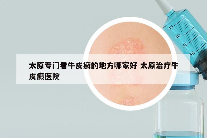 太原专门看牛皮癣的地方哪家好 太原治疗牛皮癜医院