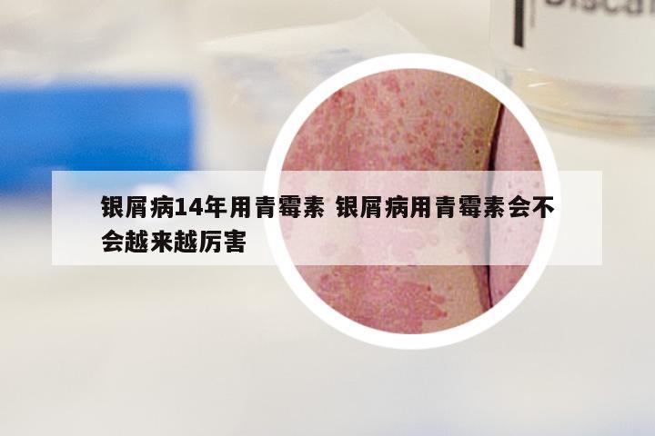 银屑病14年用青霉素 银屑病用青霉素会不会越来越厉害