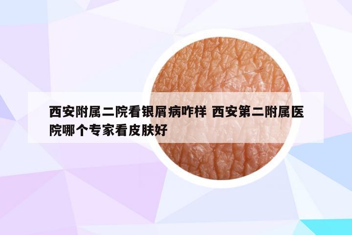 西安附属二院看银屑病咋样 西安第二附属医院哪个专家看皮肤好