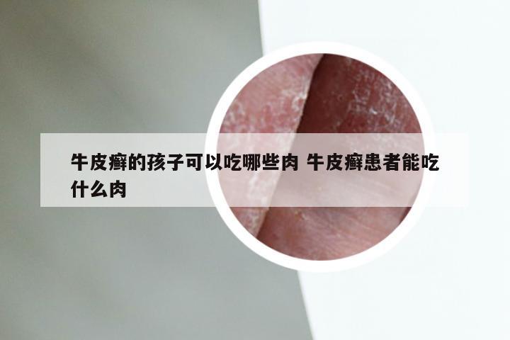 牛皮癣的孩子可以吃哪些肉 牛皮癣患者能吃什么肉