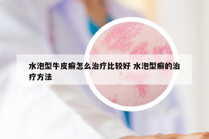 水泡型牛皮癣怎么治疗比较好 水泡型癣的治疗方法
