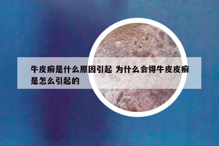 牛皮癣是什么原因引起 为什么会得牛皮皮癣是怎么引起的