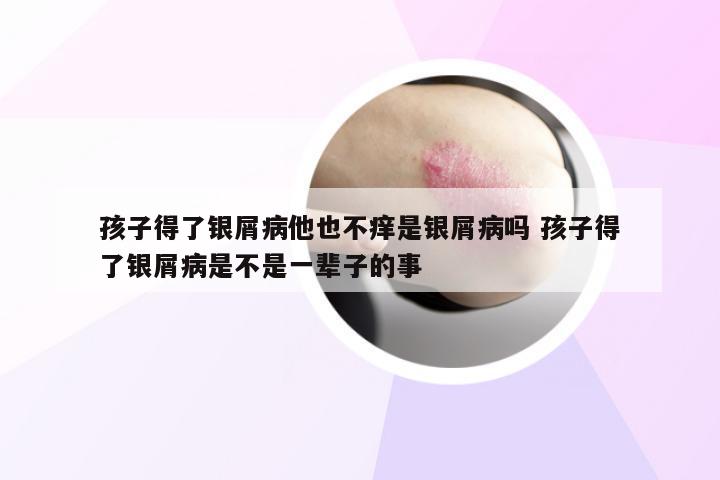 孩子得了银屑病他也不痒是银屑病吗 孩子得了银屑病是不是一辈子的事
