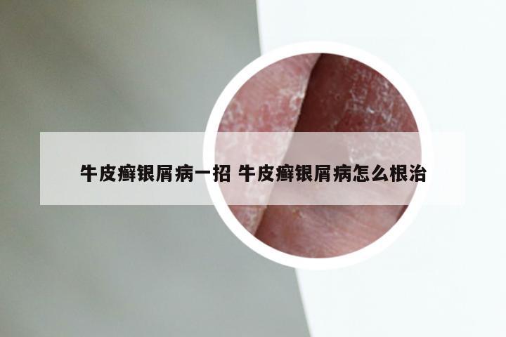 牛皮癣银屑病一招 牛皮癣银屑病怎么根治