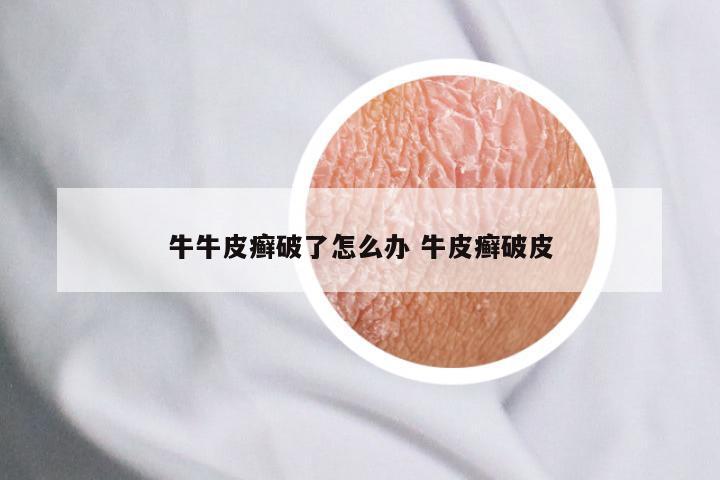 牛牛皮癣破了怎么办 牛皮癣破皮