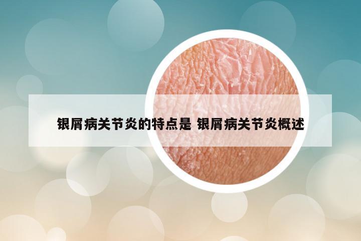 银屑病关节炎的特点是 银屑病关节炎概述