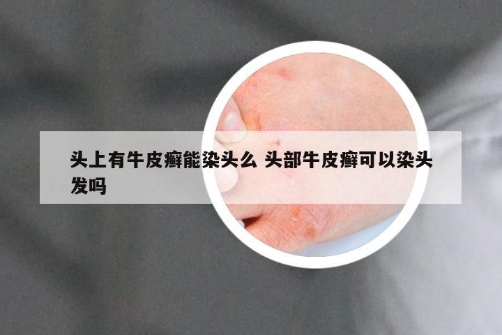 头上有牛皮癣能染头么 头部牛皮癣可以染头发吗