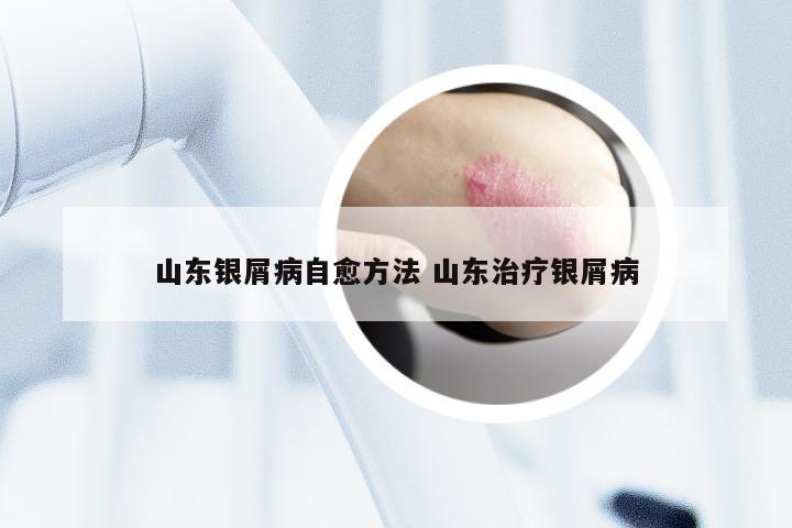 山东银屑病自愈方法 山东治疗银屑病