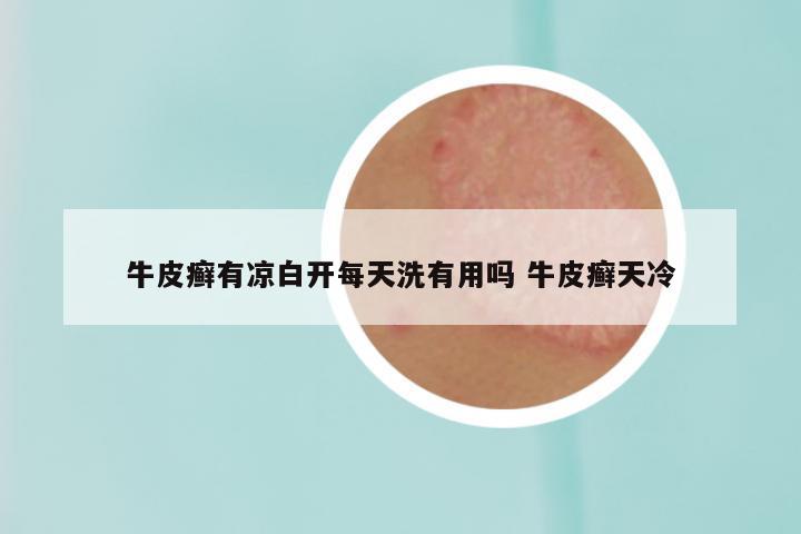 牛皮癣有凉白开每天洗有用吗 牛皮癣天冷