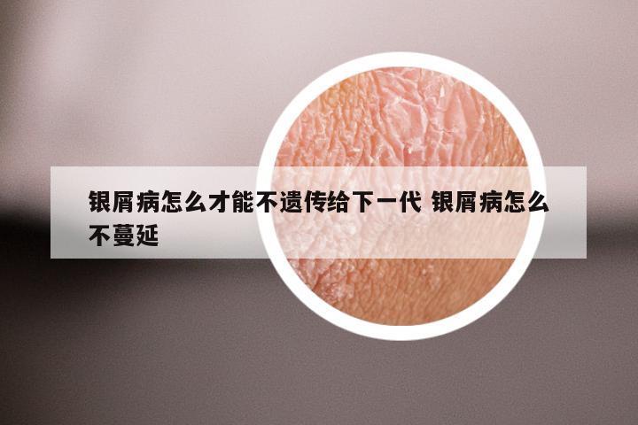 银屑病怎么才能不遗传给下一代 银屑病怎么不蔓延