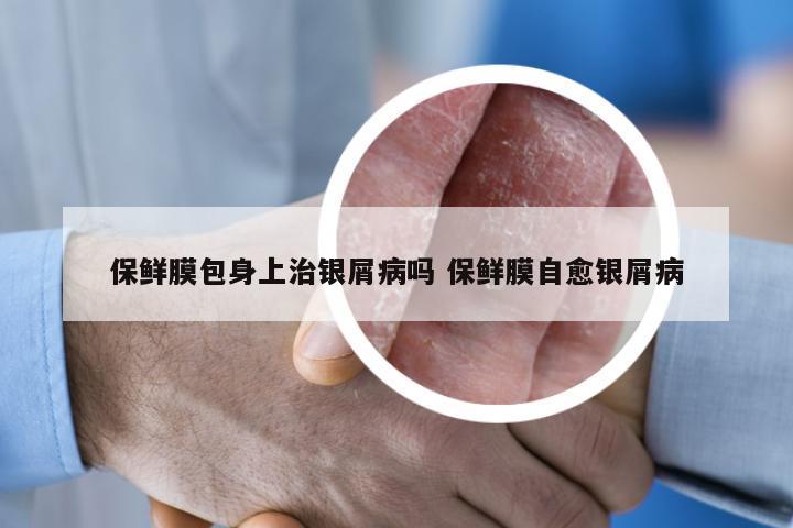 保鲜膜包身上治银屑病吗 保鲜膜自愈银屑病