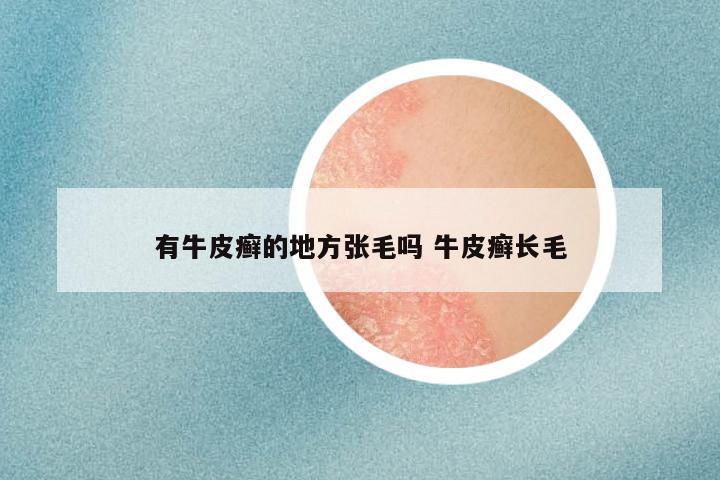 有牛皮癣的地方张毛吗 牛皮癣长毛