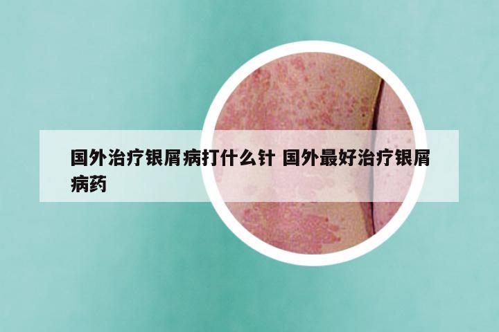 国外治疗银屑病打什么针 国外最好治疗银屑病药