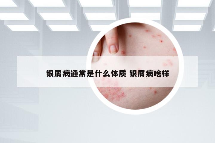 银屑病通常是什么体质 银屑病啥样