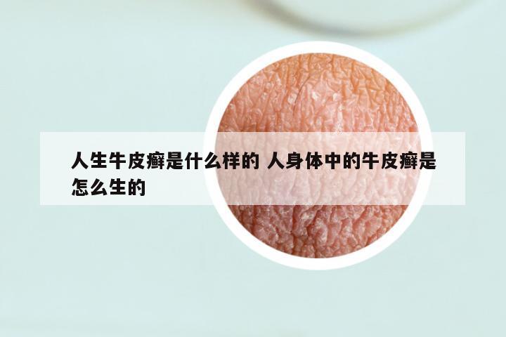 人生牛皮癣是什么样的 人身体中的牛皮癣是怎么生的