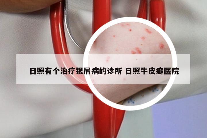 日照有个治疗银屑病的诊所 日照牛皮癣医院