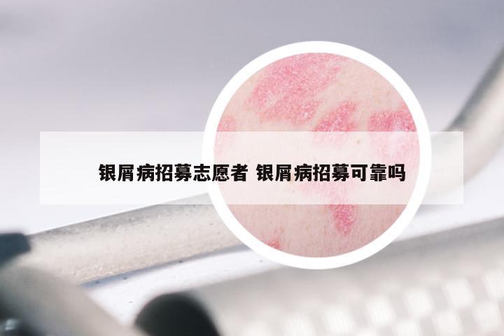 银屑病招募志愿者 银屑病招募可靠吗