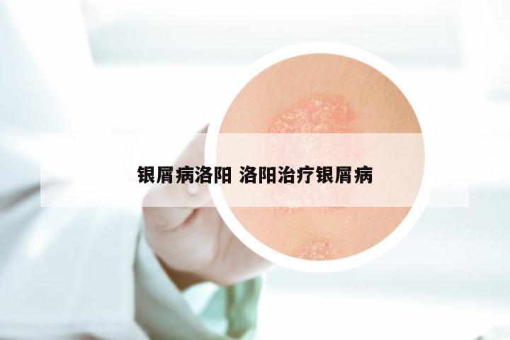 银屑病洛阳 洛阳治疗银屑病