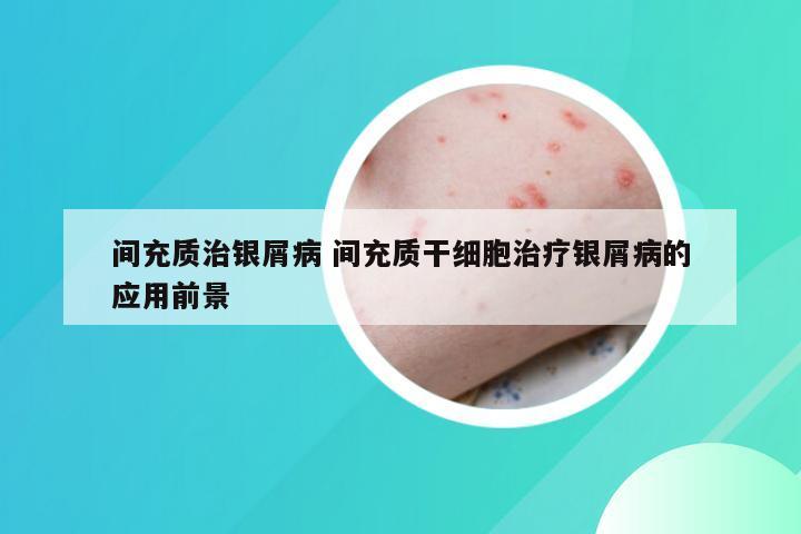 间充质治银屑病 间充质干细胞治疗银屑病的应用前景