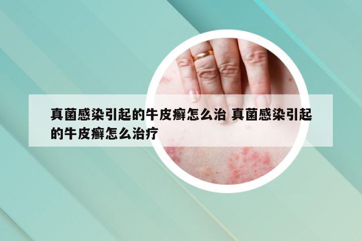 真菌感染引起的牛皮癣怎么治 真菌感染引起的牛皮癣怎么治疗
