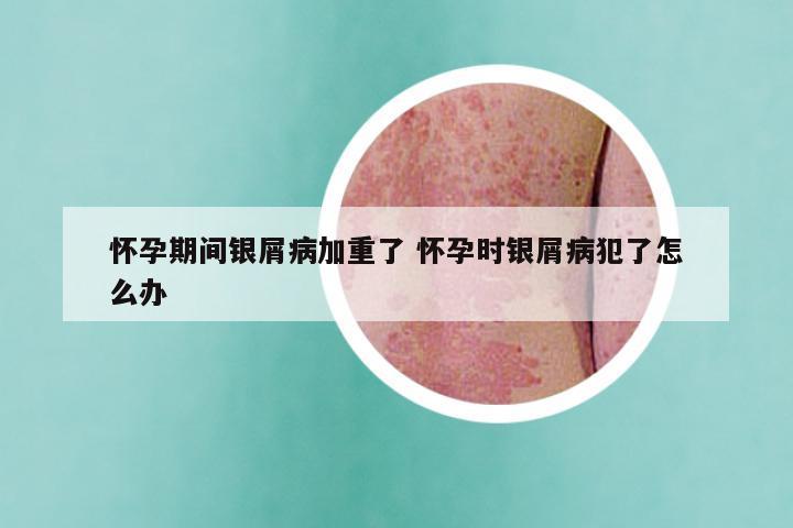怀孕期间银屑病加重了 怀孕时银屑病犯了怎么办