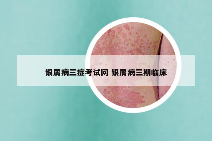 银屑病三症考试网 银屑病三期临床