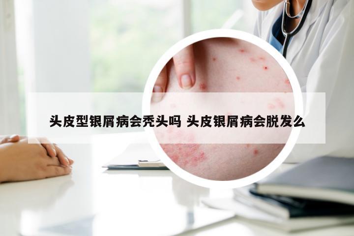 头皮型银屑病会秃头吗 头皮银屑病会脱发么