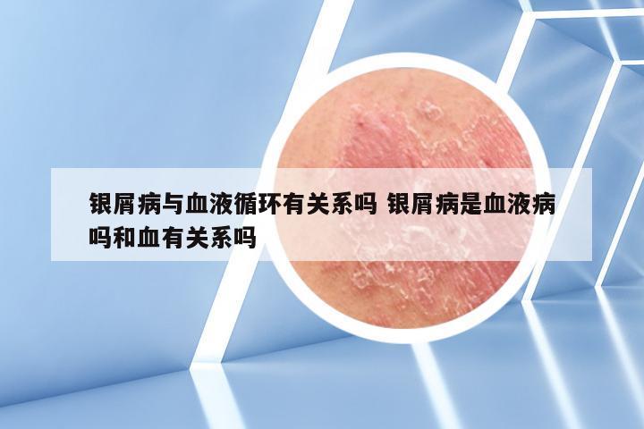 银屑病与血液循环有关系吗 银屑病是血液病吗和血有关系吗