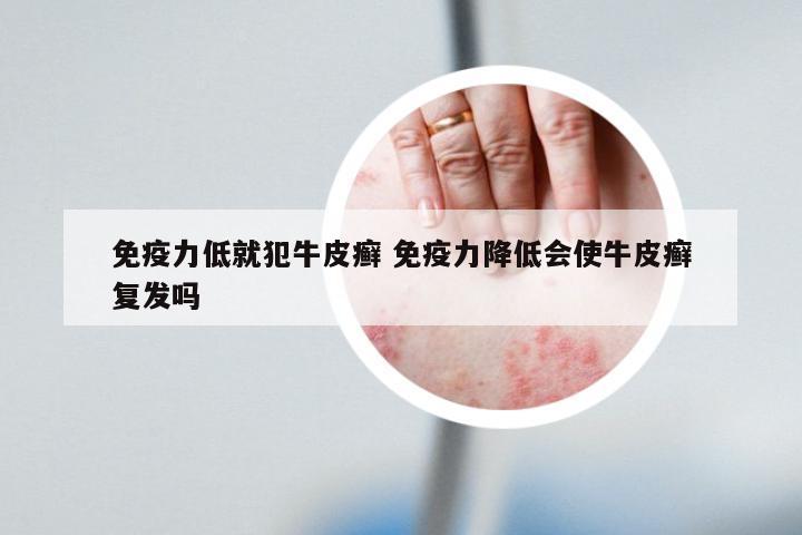 免疫力低就犯牛皮癣 免疫力降低会使牛皮癣复发吗