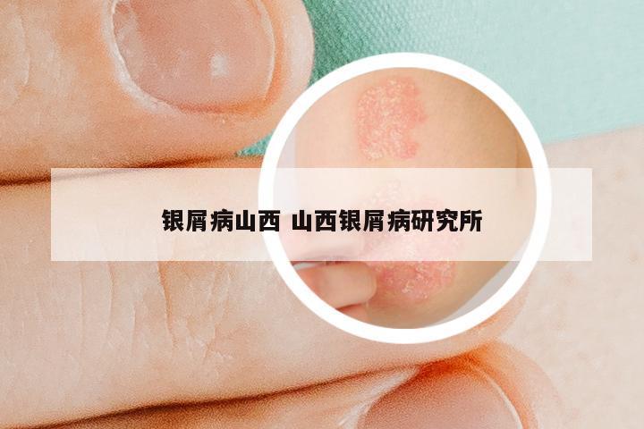 银屑病山西 山西银屑病研究所