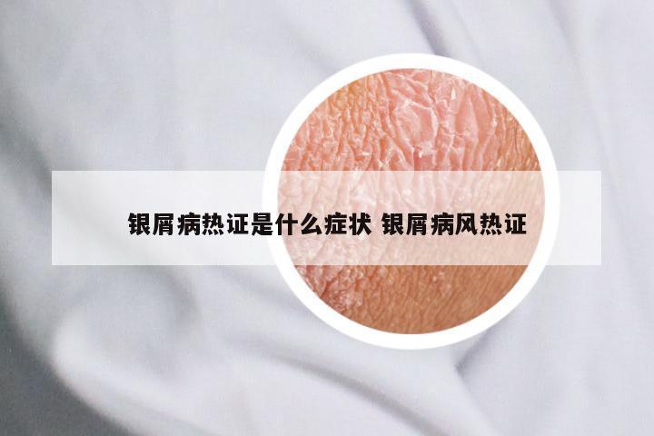 银屑病热证是什么症状 银屑病风热证