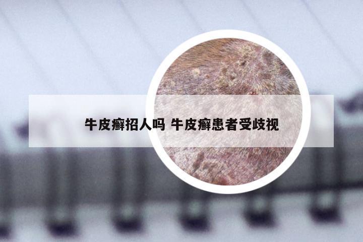 牛皮癣招人吗 牛皮癣患者受歧视