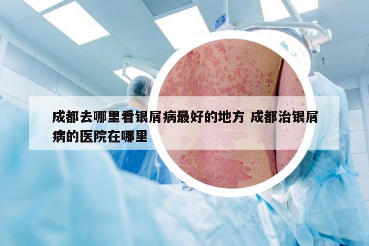 成都去哪里看银屑病最好的地方 成都治银屑病的医院在哪里