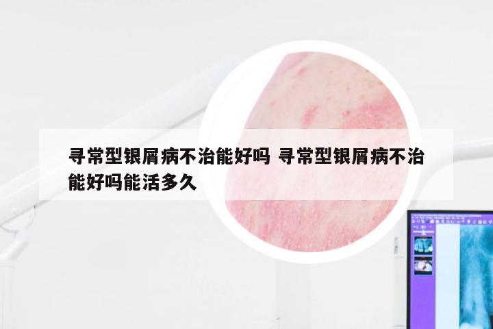寻常型银屑病不治能好吗 寻常型银屑病不治能好吗能活多久