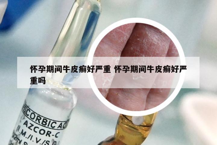 怀孕期间牛皮癣好严重 怀孕期间牛皮癣好严重吗