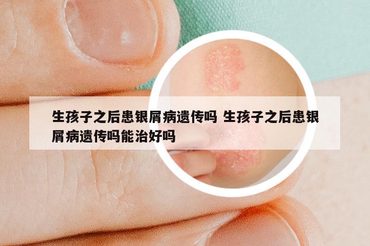 生孩子之后患银屑病遗传吗 生孩子之后患银屑病遗传吗能治好吗
