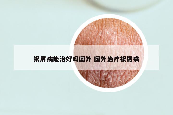 银屑病能治好吗国外 国外治疗银屑病