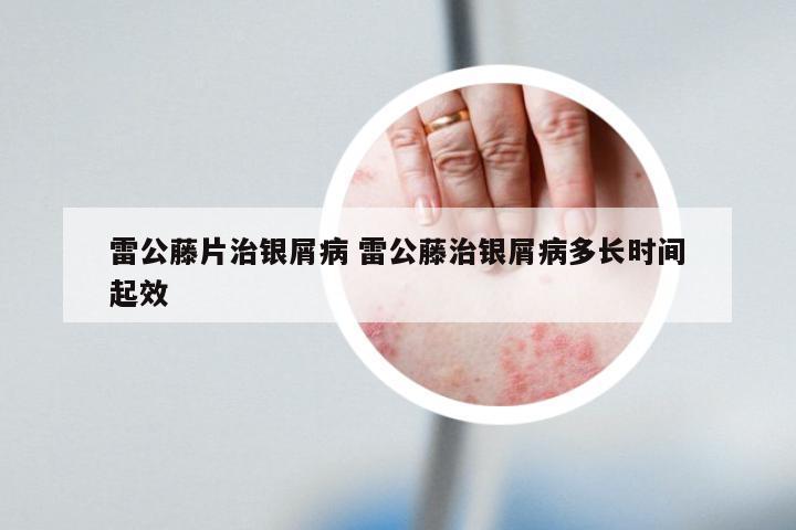 雷公藤片治银屑病 雷公藤治银屑病多长时间起效