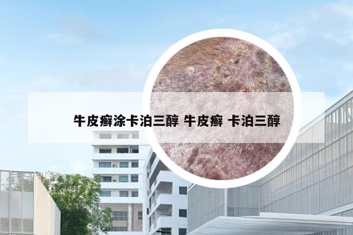 牛皮癣涂卡泊三醇 牛皮癣 卡泊三醇
