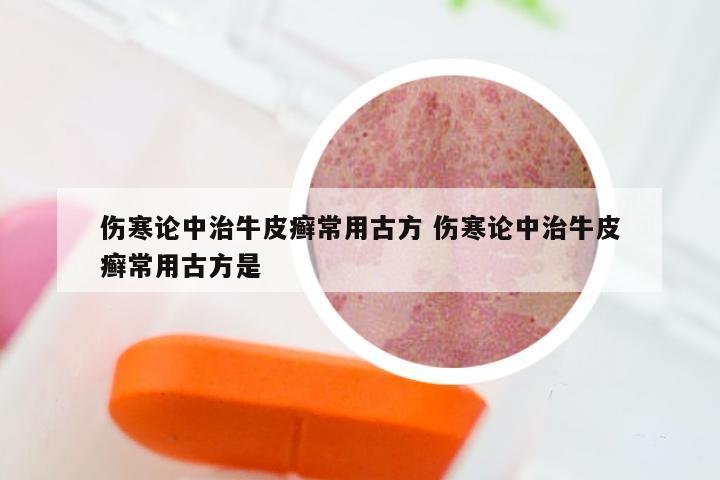 伤寒论中治牛皮癣常用古方 伤寒论中治牛皮癣常用古方是