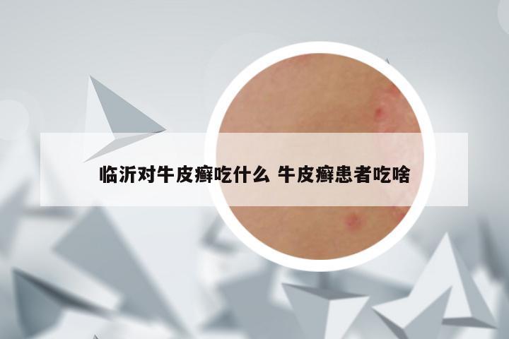 临沂对牛皮癣吃什么 牛皮癣患者吃啥