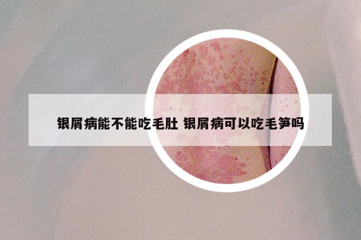 银屑病能不能吃毛肚 银屑病可以吃毛笋吗