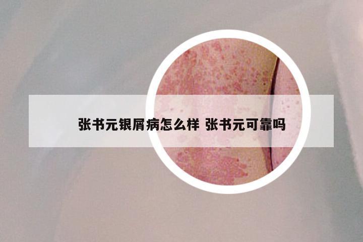 张书元银屑病怎么样 张书元可靠吗