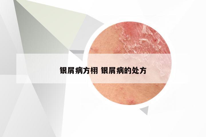 银屑病方栩 银屑病的处方